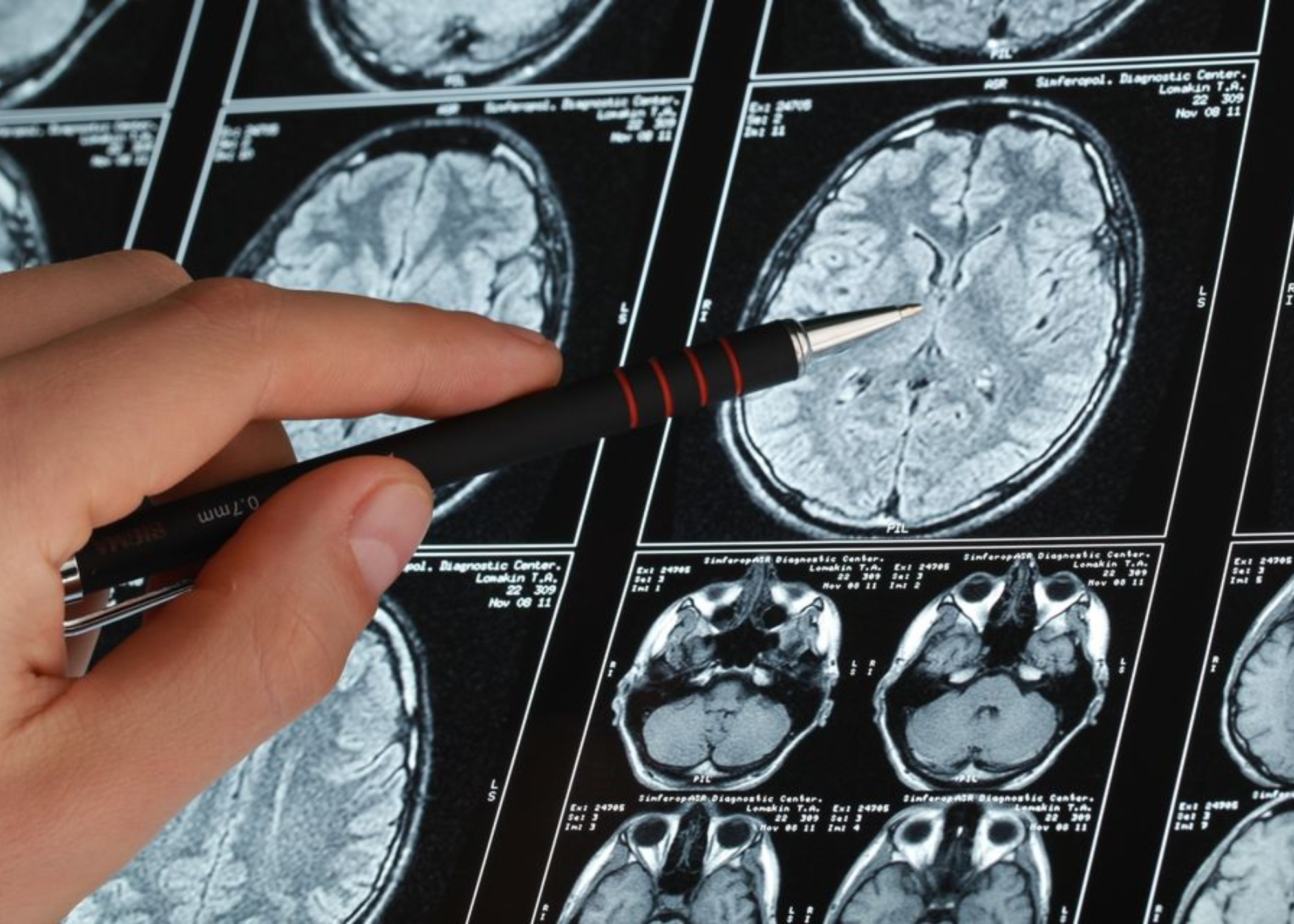 A Drug From Two Biotech Companies Slowed Cognitive Decline By 27%